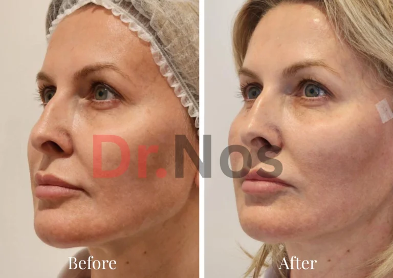 Before After Sculptra 2