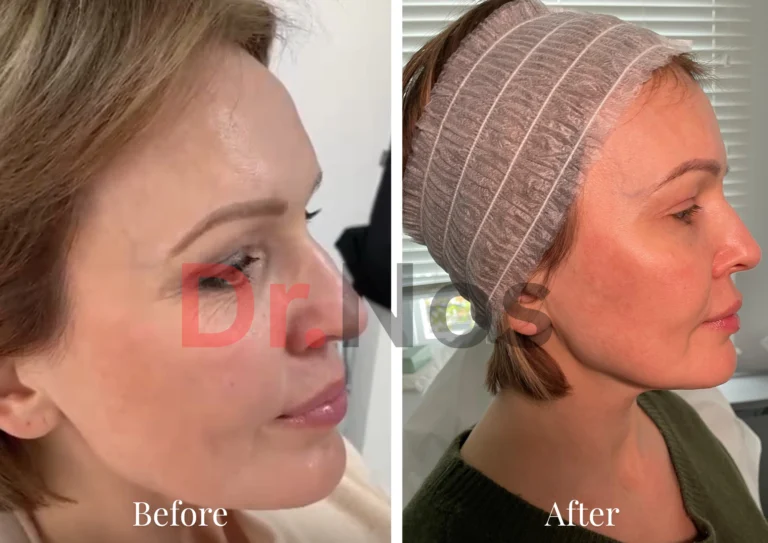 Before After Sculptra 3