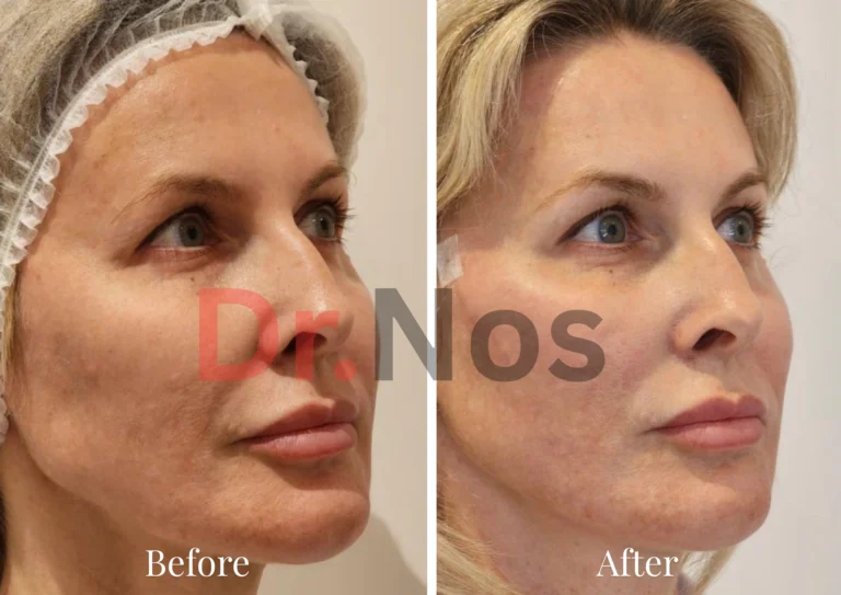 Before After Sculptra