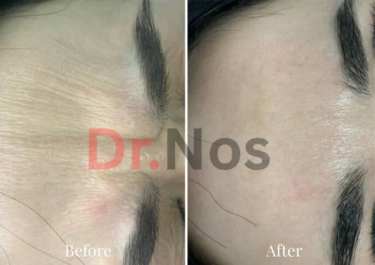 Anti-Wrinkle Treatment Result