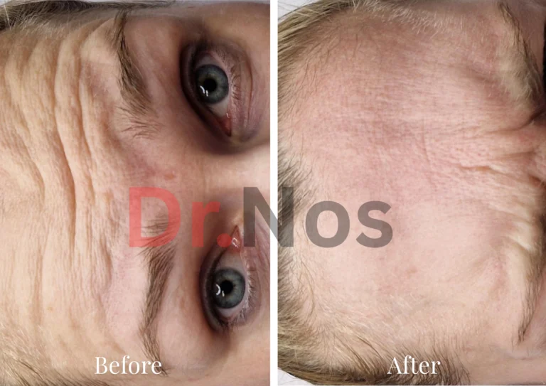 Anti-Wrinkle Before After 2