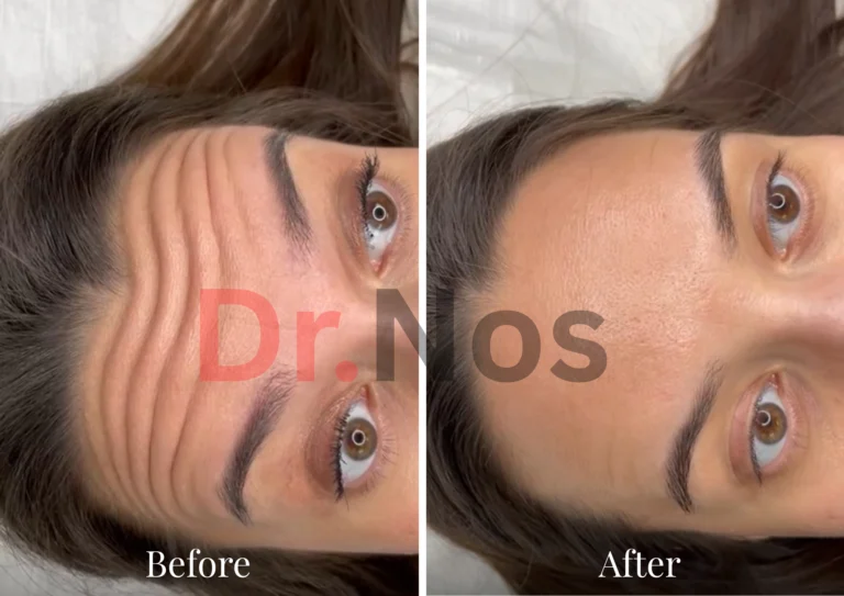 Anti-Wrinkle 2 Weeks Transformation