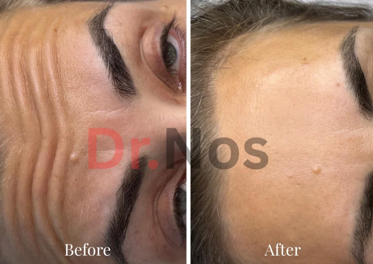 Anti-Wrinkle Before After 3