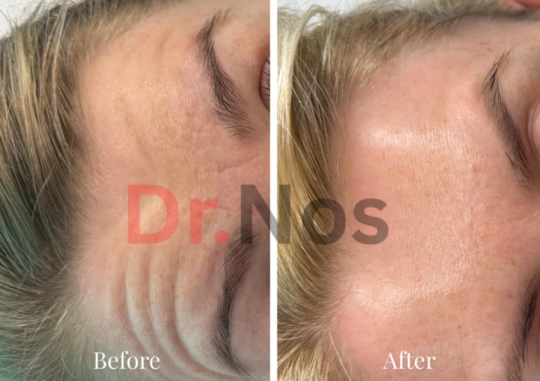 Anti-Wrinkle Before After 5