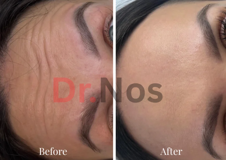 Anti-Wrinkle Before After 6