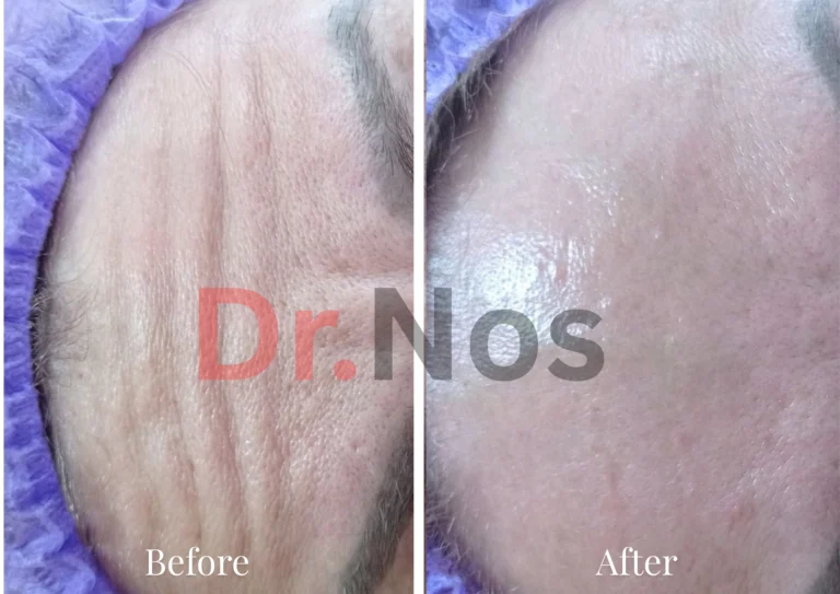 Anti-Wrinkle Before After