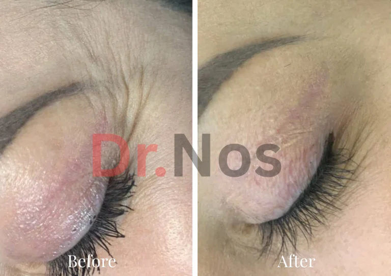 Anti-Wrinkle Eyes Before After 2