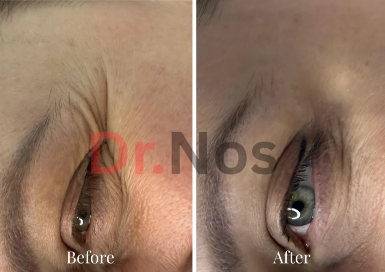 Anti-Wrinkle Eyes Before After 4