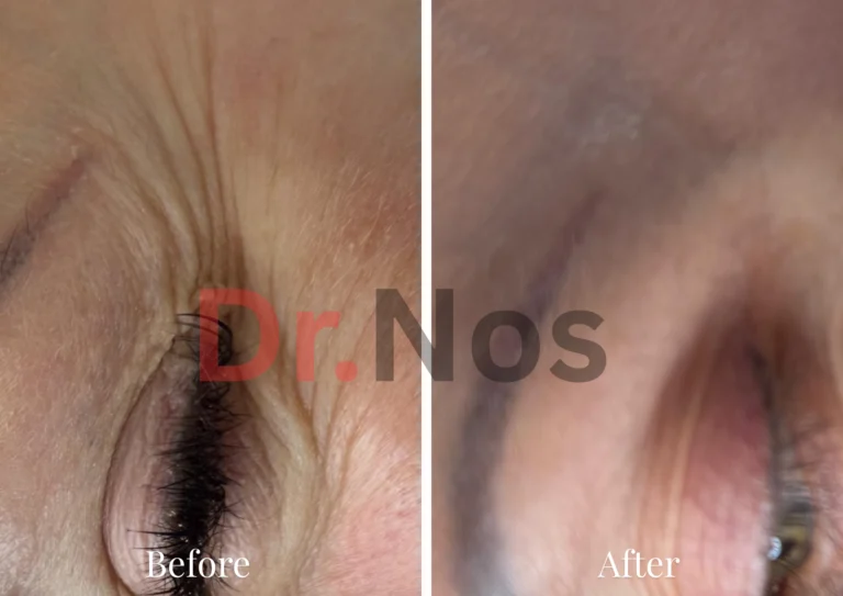 Anti-Wrinkle Treatment Result