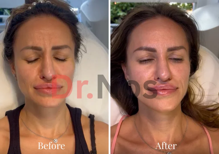Full Face Anti-Wrinkle Before After